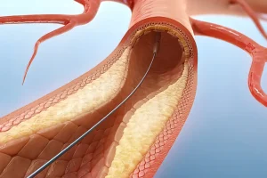 Illustrative image of arterial stenting, Cluj-Napoca, arteries, vascular surgery clinic