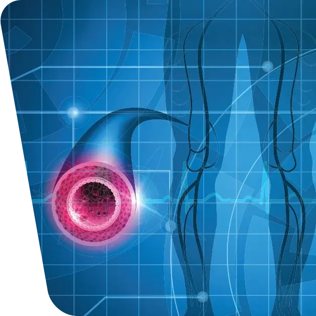 Imaginea ilustrează o reprezentare grafică a arterelor la nivelul picioarelor, evidențiind aspecte asociate cu boala arterială periferică. Aflați mai multe despre diagnostic, tratament și gestionarea acestei afecțiuni în articolul nostru specializat.