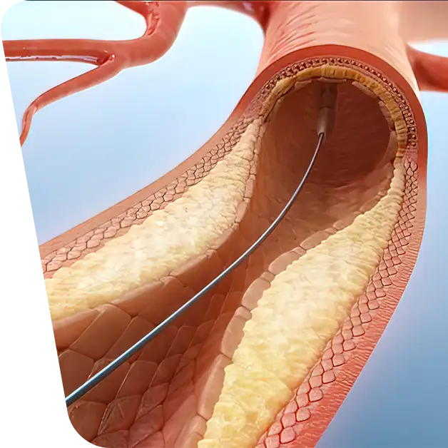 Imagine explicativa a stentării arteriale, cluj napoca, artere, clinica de chirurgie vasculara