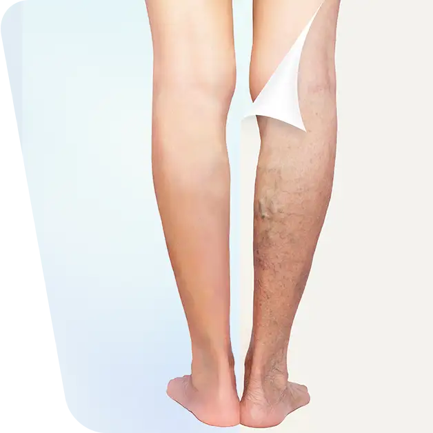 Imaginea evidențiază transformarea unei perechi de picioare afectate de varice, înainte și după procedura de tratament. Descoperiți rezultatele remarcabile ale intervenției în articolul nostru specializat despre tratamentul varicelor.