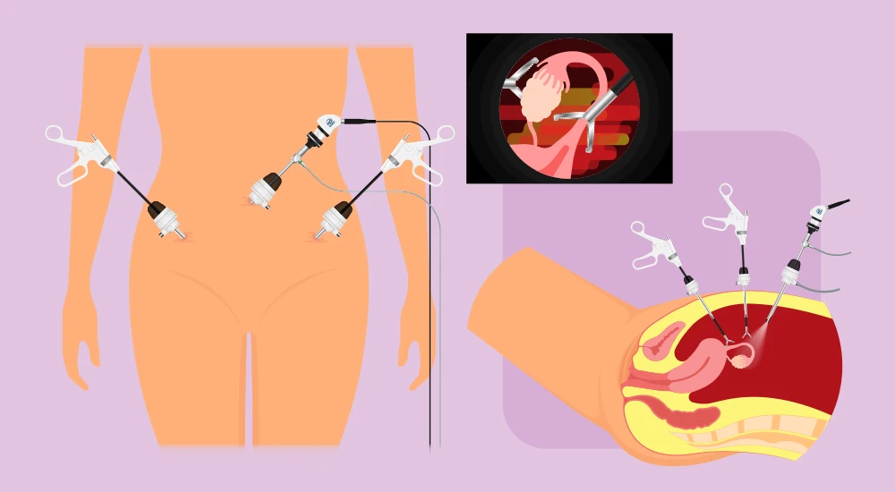 Imaginea redă o perspectivă detaliată asupra intervenției de histerectomie laparoscopică, evidențiind instrumentele medicale și tehnicile chirurgicale utilizate.