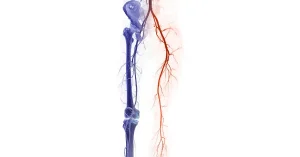 CTA artera femurală arată artera femurală pentru diagnosticarea bolii arteriale periferice acute sau cronice