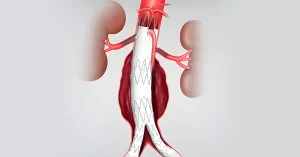 The picture illustrates an EVAR procedure for aortic aneurysm.