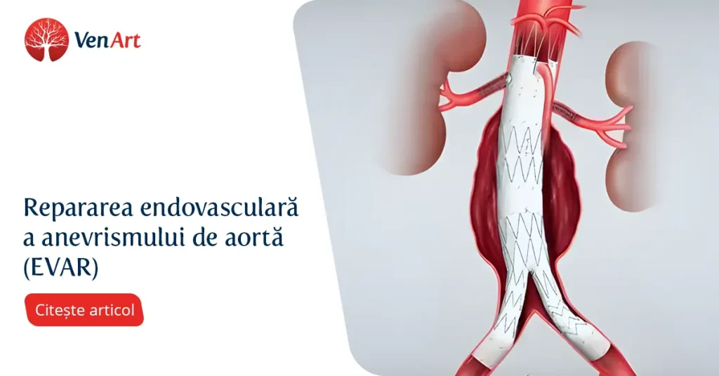 Eva R Santa Endovascular Aortic Aneurysm Repair (EVAR) | VenArt Clinic