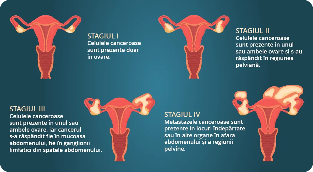 Sistemul reproducător al femeii - ilustrație a cancerului ovarian - patru stadii care menționează ovarele - regiunea pelviană - mucoasa abdomenului și metastazele