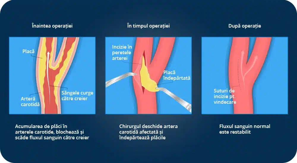 Imagini ilustrative în cadrul articolului despre operația de arteră carotidă: înaintea operației, în timpul operației și după operație de carotida, evidențiind etapele procedurii medicale de endarterectomia carotidiană