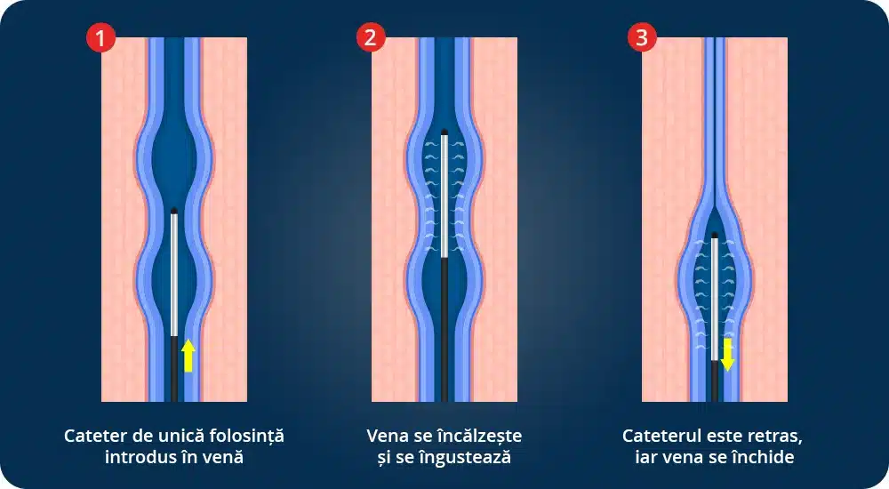 Radiofrecvența VNUS: tratament minim invaziv pentru venele varicoase