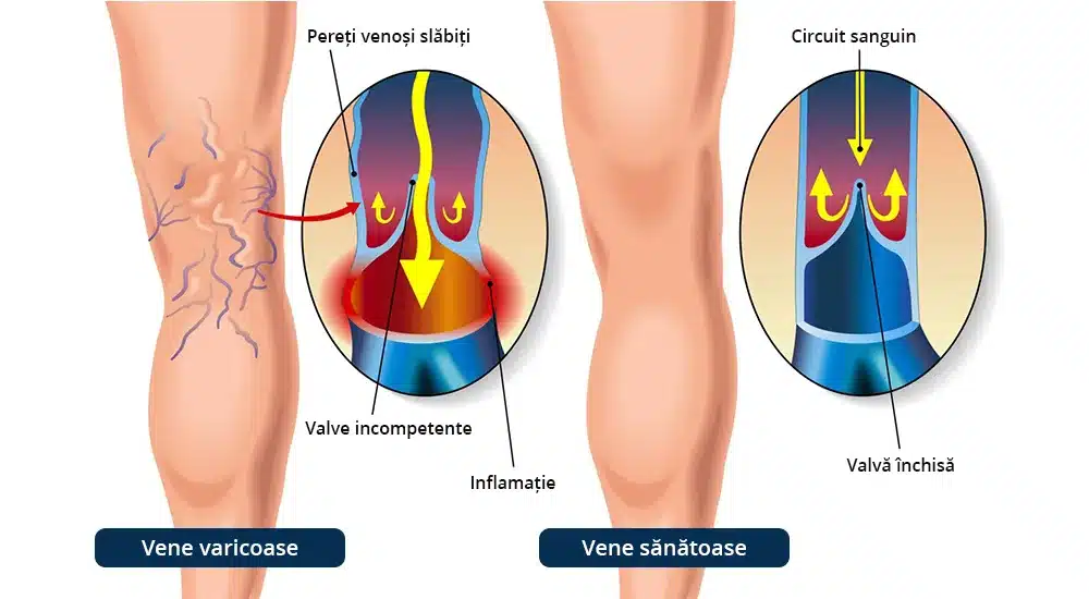 Tratament varice, Ilustrație comparativă între un picior cu varice și același picior după operația de varice, evidențiind îmbunătățirea circulației sanguine și rezultatele tratamentului.