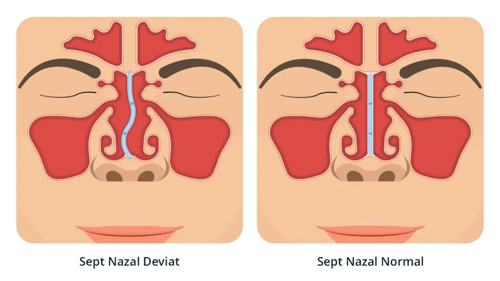 Imaginea evidențiază diferența între un sept nazal deviat și un sept nazal normal. Ilustrează impactul structural al deviației septului nazal care provoaca sforait și necesitatea unui tratament adecvat.