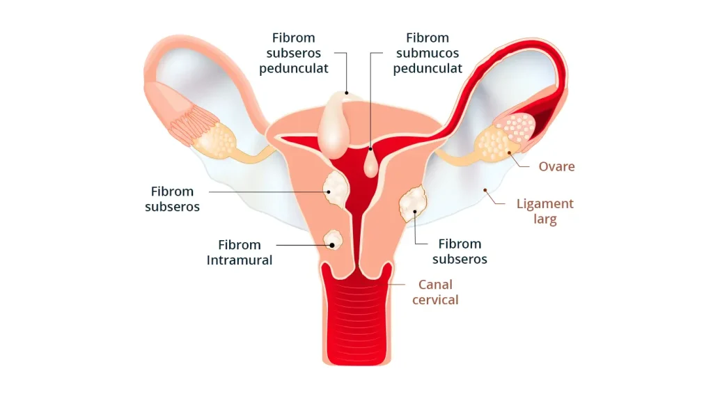 Imaginea prezintă un desen care evidențează tipurile de fibromul uterin. Ilustrează structura și locația acestor formațiuni, oferind o perspectivă vizuală pentru înțelegerea mai profundă a afecțiunii.