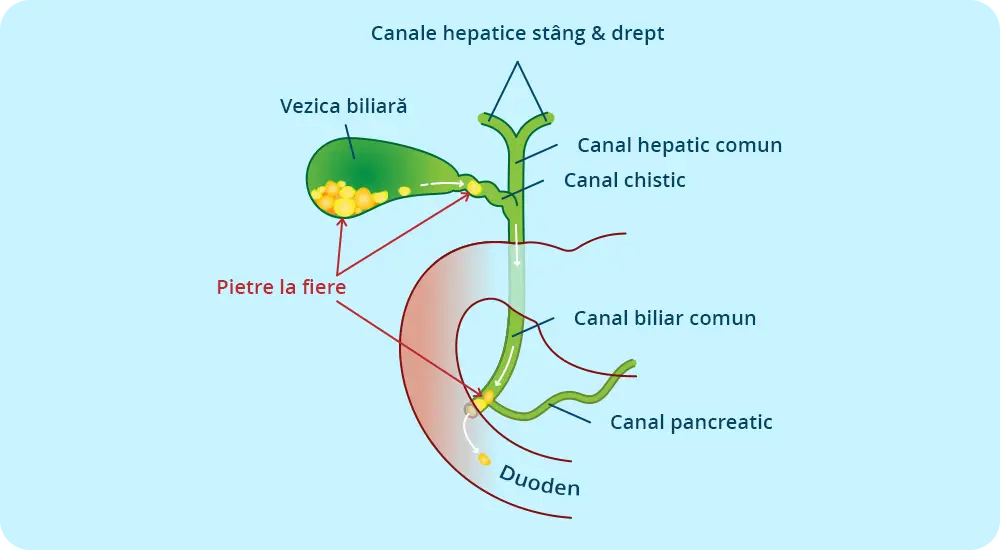 Imaginea redă un desen ilustrativ detaliat a canalelor hepatice stâng și drept cu informații despre vezica biliară, pietre la fiere, canalul biliar comun și duoden