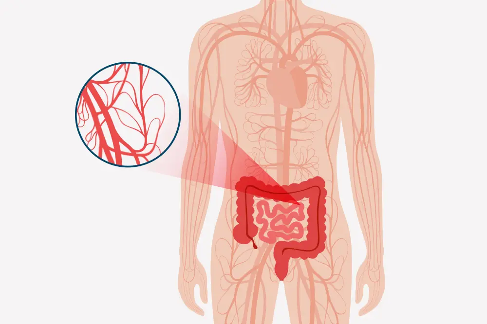 Imaginea redă un desen ilustrativ cu detalii anatomice ale intestinului, evidențiind zona de investigație în contextul procedurilor de angiografie și angioplastie a arterelor mezenterice. Aflați cum aceste tehnici contribuie la diagnosticul și tratamentul afecțiunilor vasculare mezenterice.