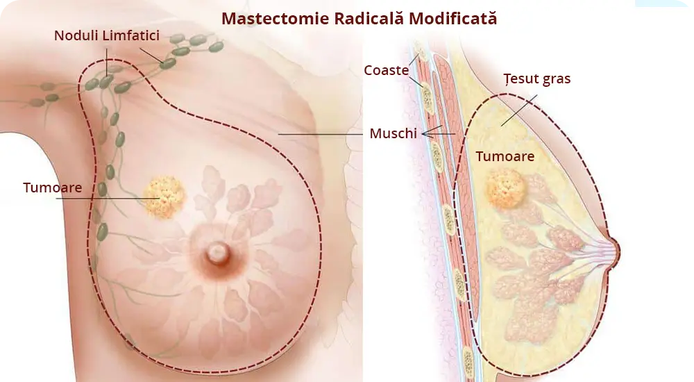 Mastectomie Radicala Modificata