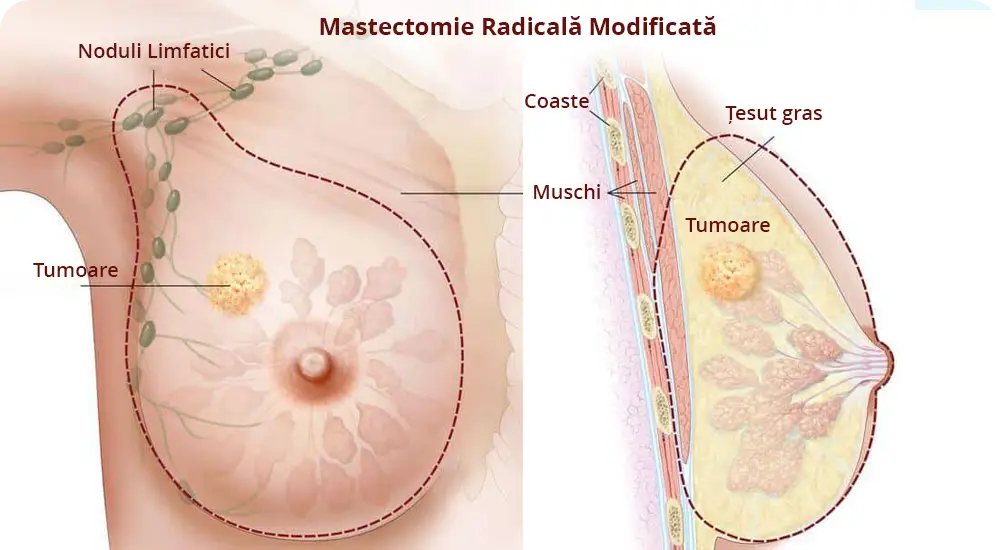 Imaginea este un desen ilustrativ care ne arată cum arată mastectomia radicală modificată, nodulii limfatici, șesutul gras și cum arată o tumoare. Această reprezentare vizuală este asociată cu informațiile din articolul medical despre mastectomie.