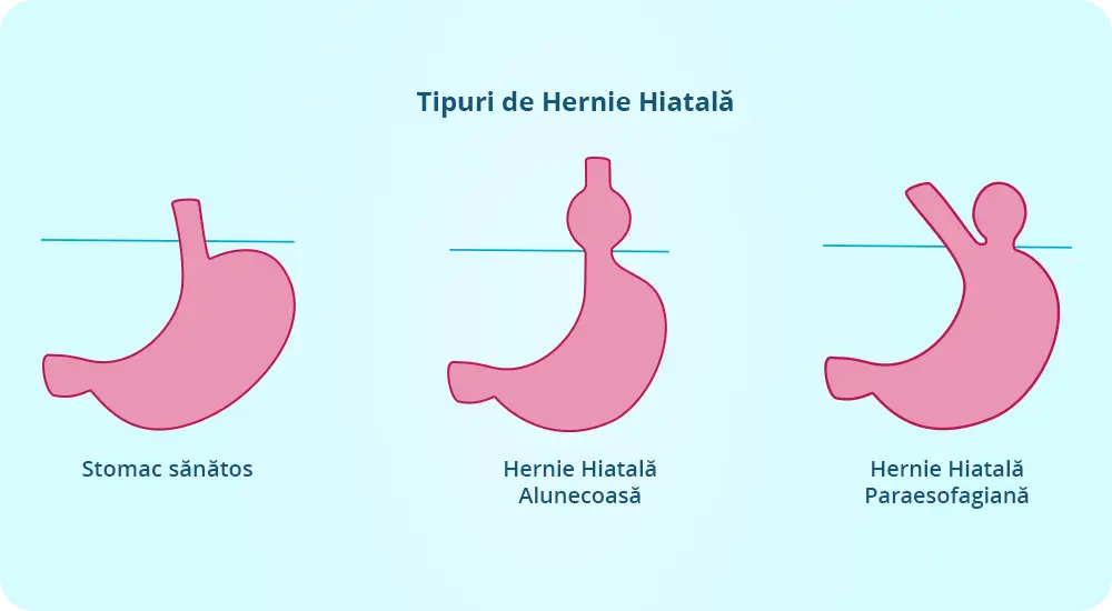 Tipuri de Hernie Hiatala