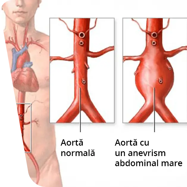 Imaginea ilustrează imaginea medicală a unui anevrism de aortă, evidențiind zona afectată și dimensiunile sale. Aflați mai multe despre cauze, simptome și opțiunile de tratament pentru această afecțiune vasculară.