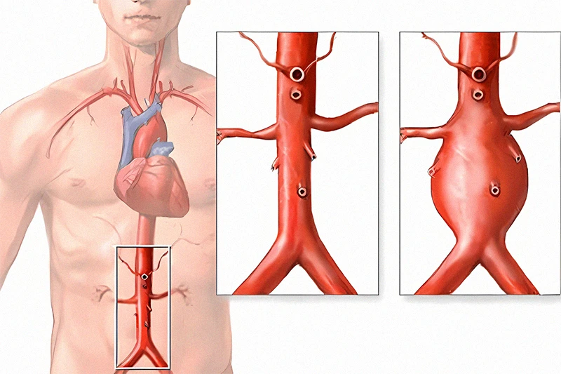 The image illustrates an aortic aneurysm, including an abdominal aortic aneurysm, highlighting the abdominal area of a human figure to indicate the location of the aneurysm.