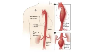The image illustrates an aortic aneurysm, including an abdominal aortic aneurysm, highlighting the abdominal area of a human figure to indicate the location of the aneurysm.