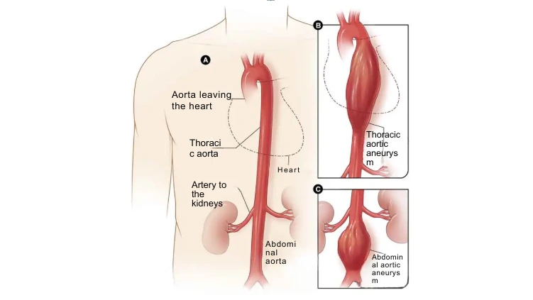 The image illustrates an aortic aneurysm, including an abdominal aortic aneurysm, highlighting the abdominal area of a human figure to indicate the location of the aneurysm.