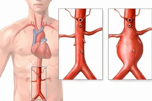 Imaginea ilustrează un anevrism aortic, inclusiv un anevrism aortic abdominal, evidențiind zona abdominală a unei figuri umane pentru a indica locația anevrismului.