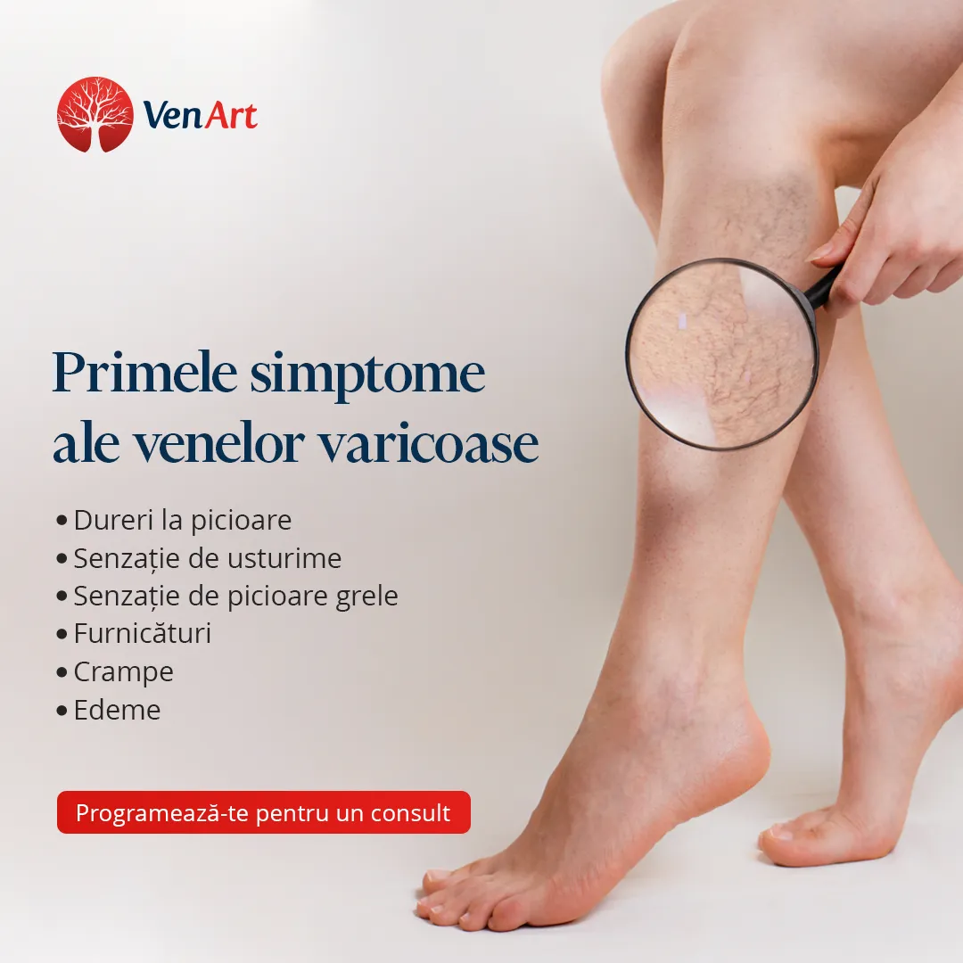 Imagine ce contine lista cu primele simptome ale venelor varicoase