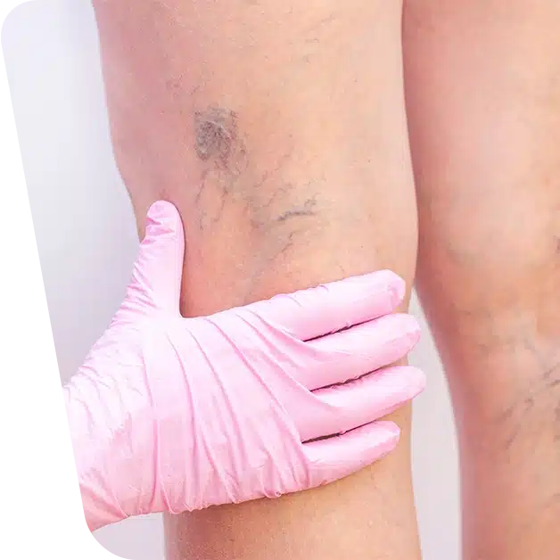 Imaginea prezintă detaliile varicelor pe un picior, evidențiind aspectele relevante pentru operația de varice. Descoperiți tot ce trebuie sa stiti despre chirurgia minim invazivă si tratamentul varicelor.