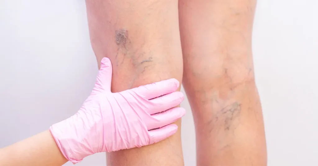 The image shows the details of varicose veins on a leg, highlighting the aspects relevant to varicose vein surgery. Find out everything you need to know about minimally invasive surgery and varicose vein treatment.