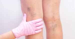 The image shows the details of varicose veins on a leg, highlighting the aspects relevant to varicose vein surgery. Find out everything you need to know about minimally invasive surgery and varicose vein treatment.