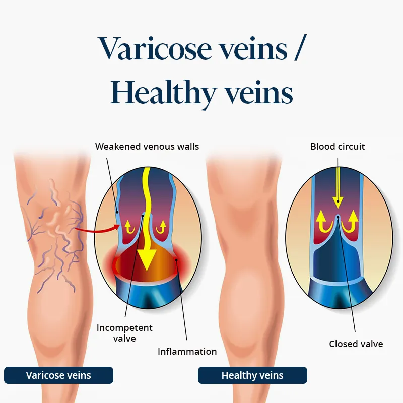 Image illustrating how a leg with varicose veins looks compared to a leg with healthy veins