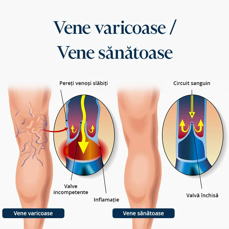 Imagine ce ilustreaza cum arata un picior cu vene varicoase in comparatie cu un picior cu vene sanatoase
