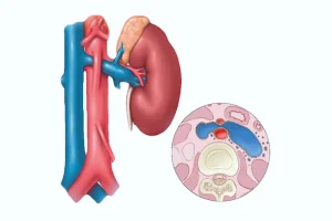 The image illustrates the venous stenting procedure used to treat Nutcracker syndrome. The stent is strategically placed to resolve compression of the renal veins, alleviating symptoms such as pain and discomfort. Revolutionary treatment for Nutcracker syndrome.