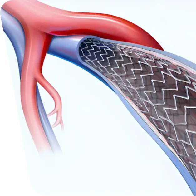 Imaginea prezintă procedura de stentare venoasă utilizată pentru tratarea sindromului post-trombotic. Un stent este plasat în venele pelvine pentru a diminua durerea și a îmbunătăți fluxul sanguin.
