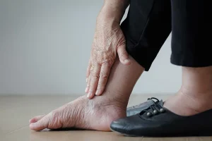Diabetic foot and signs of diabetic foot.