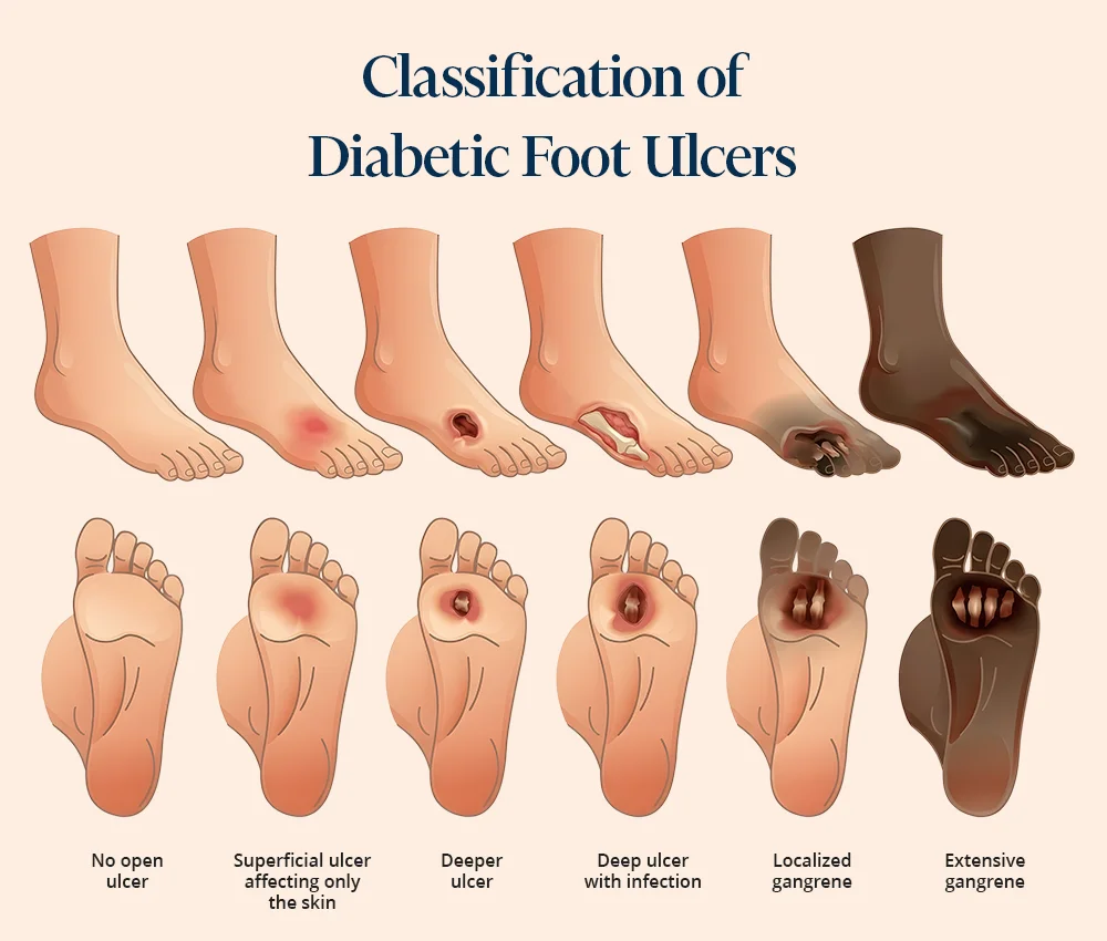 Medical illustration showing the classification of diabetic foot ulcers: from no open ulcer to deep ulcer, infected ulcers, and extensive gangrene of the foot.