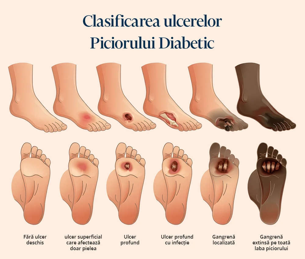Ilustrație medicală cu clasificarea ulcerelor piciorului diabetic: de la fără ulcer deschis până la ulcer profund, ulcere infectate și gangrenă extinsă a labei piciorului.