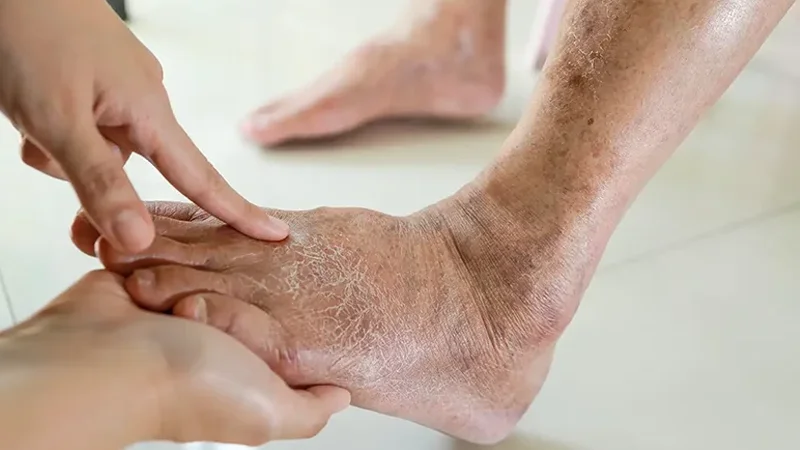 Poza ilustreaza o imagine cu piciorul diabetic, cum ar trebui autoexaminat, este putin unflat si ar trebui urmat un tratament al piciorului diabetic.