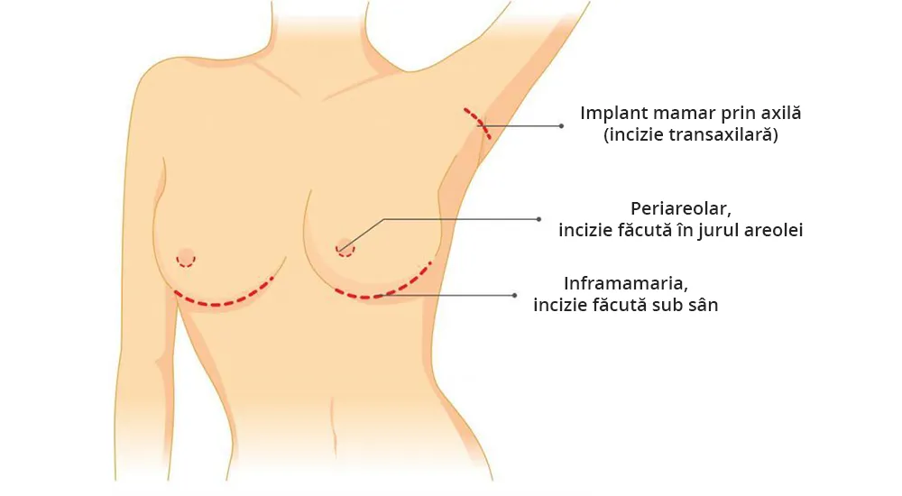 Imaginea ilustrează tipuri de cicatrici dupa operatia
mamară zis si augmentare mamara.
