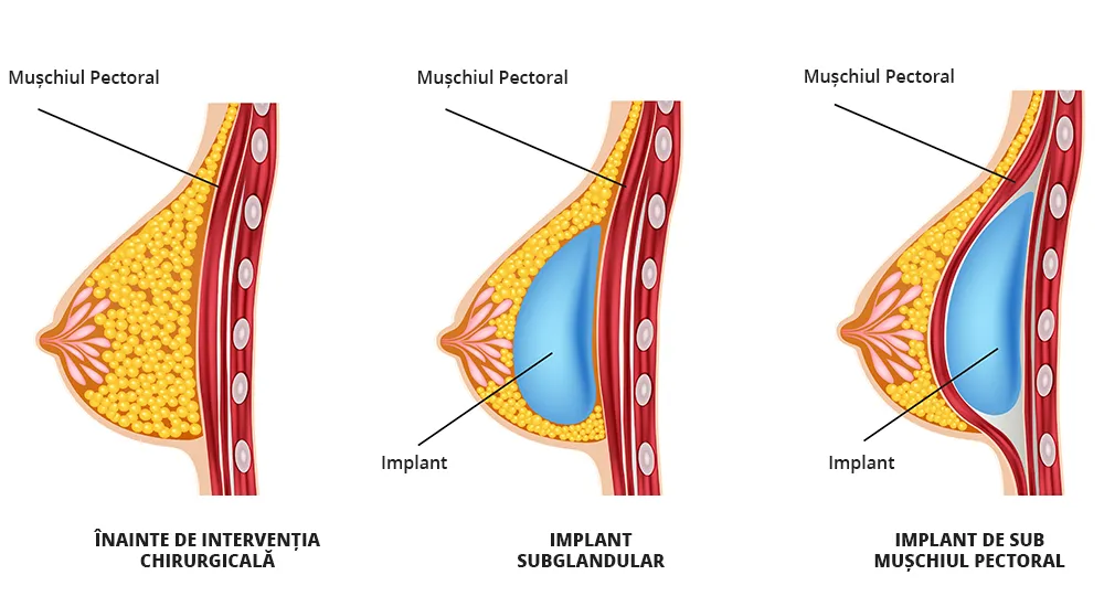 Imaginea ilustrează diferite tipuri de implant mamar zis si augmentare mamara.