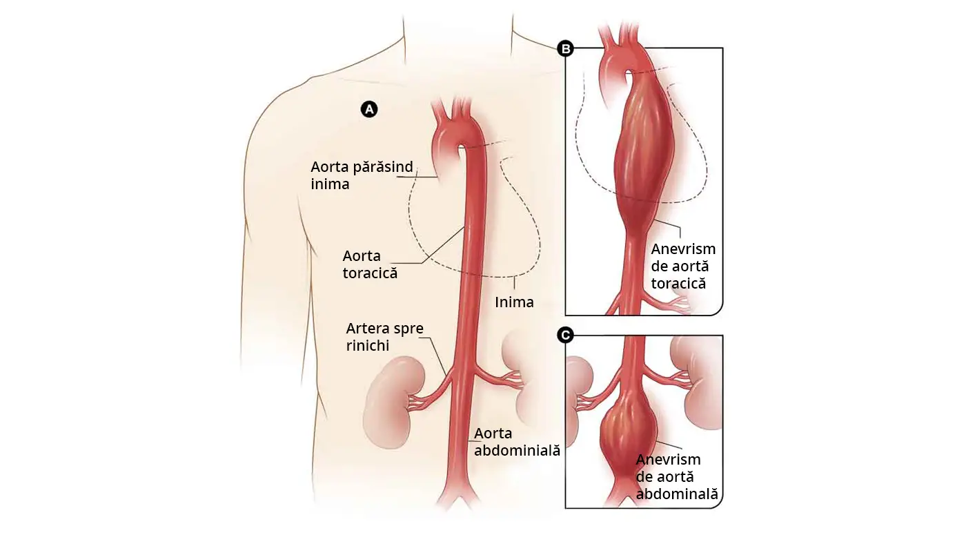 Imaginea ilustrează anatomia și diagnosticul unui anevrism aortic, anevrismul aortic abdominal, evidențiind cauzele, simptomele și opțiunile de tratament ale acestei afecțiuni vasculare.