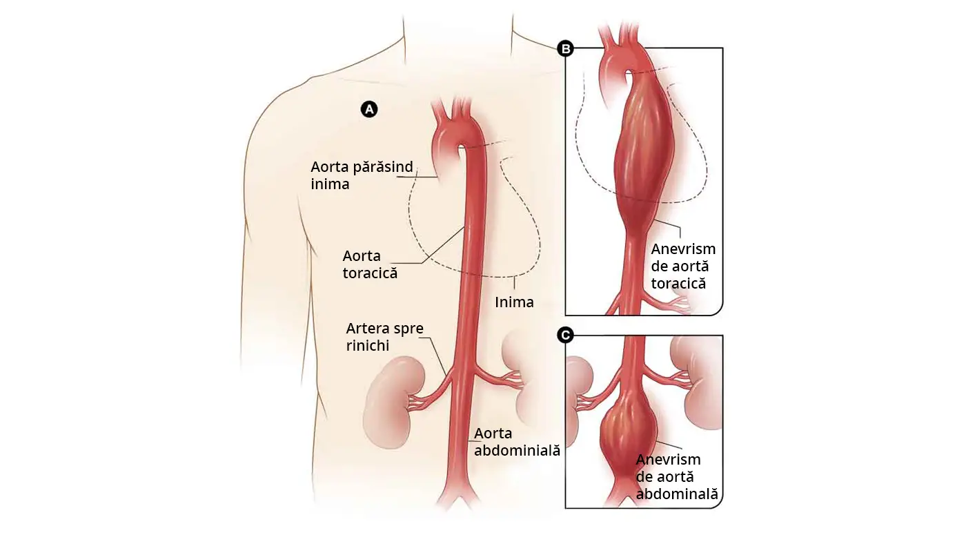 Imaginea ilustrează anatomia și diagnosticul unui anevrism aortic, anevrismul aortic abdominal, evidențiind cauzele, simptomele și opțiunile de tratament ale acestei afecțiuni vasculare numite anevrismul de aorta.