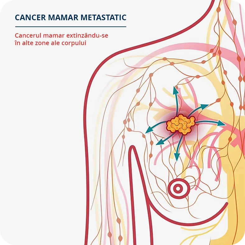 Desen: cancer mamar metastatic cum se extinde in alte zone ale corpului