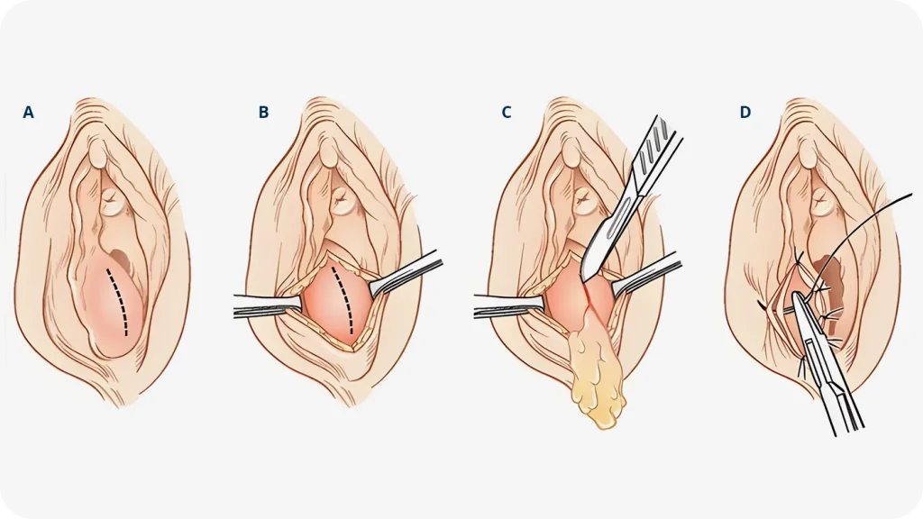 În imagine putem observa care sunt etapele unui drenaj chirurgical al glandei lui Bartholin