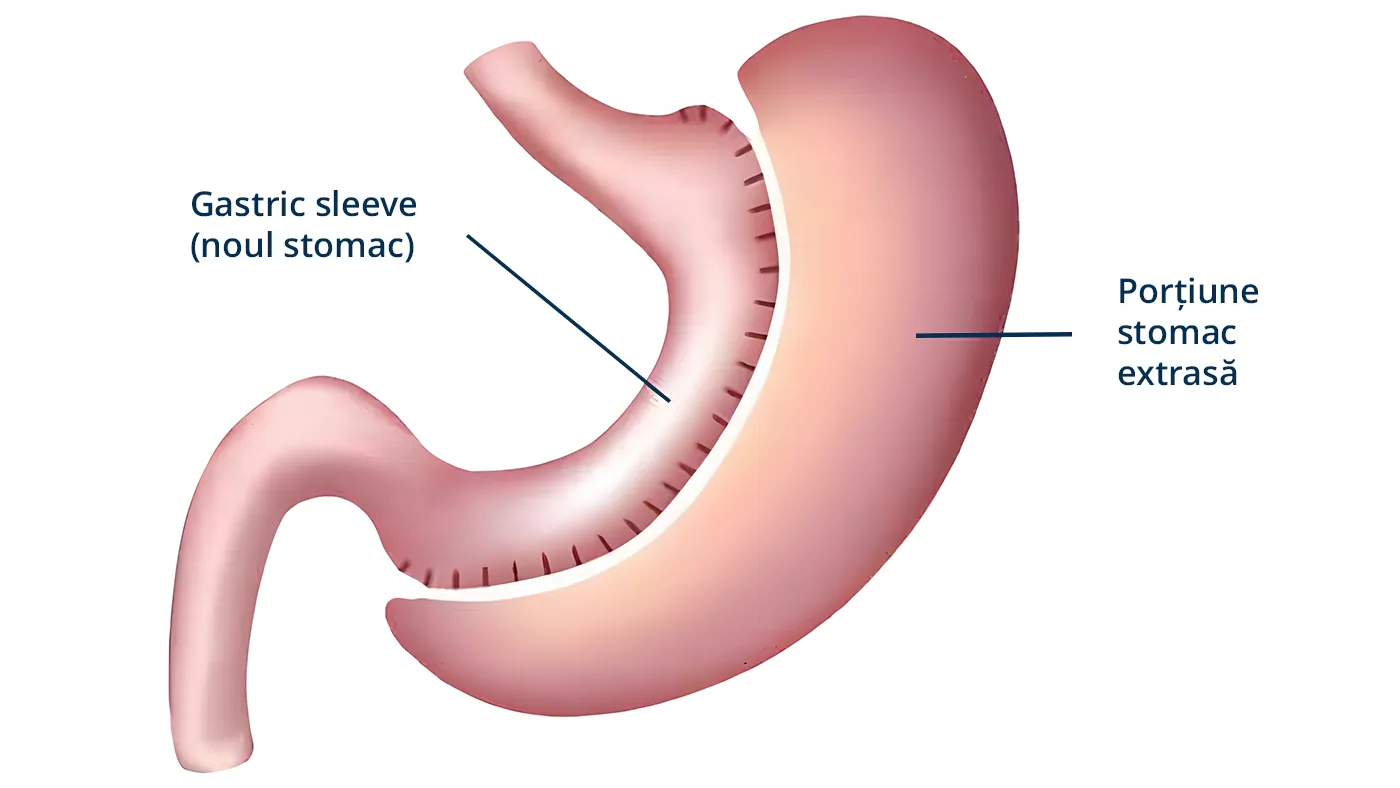 Imaginea ilustrează aspectul modificat al stomacului după intervenția de Gastric Sleeve, operația de micșorare a stomacului. Reprezentare a stomacului extras în timpul procedurii chirurgicale. Explorează beneficiile și implicațiile acestei intervenții în articolul nostru dedicat.