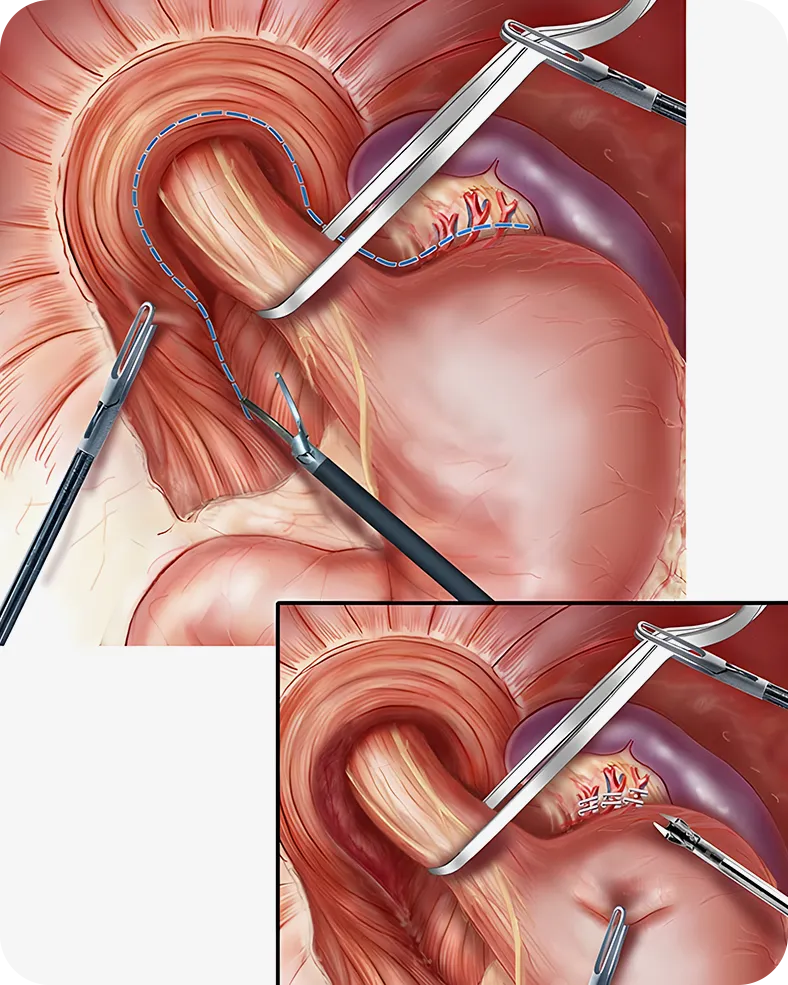 Tratamentul chirurgical al herniei hiatale