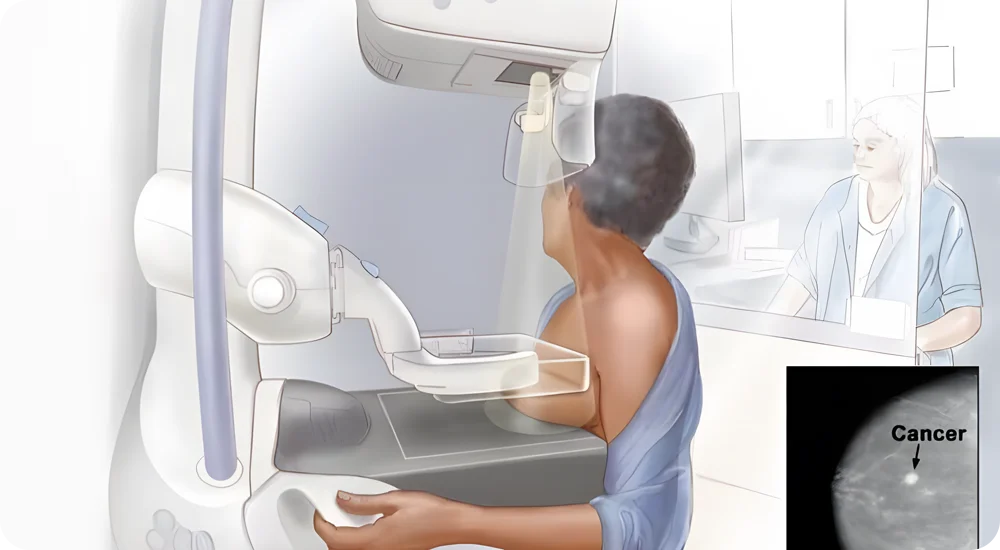 Mamografie. Sânul este presat între două plăci. Sunt folosite raze X pentru a capta imagini ale țesutului mamar.