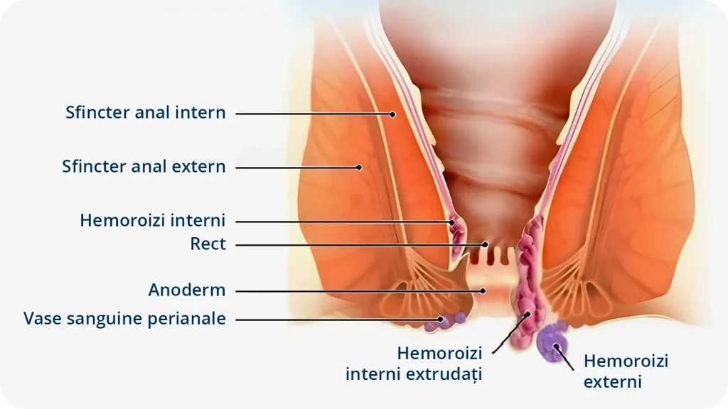 Desen grafic detaliat ilustrând hemoroizi interni și hemoroizi externi.
