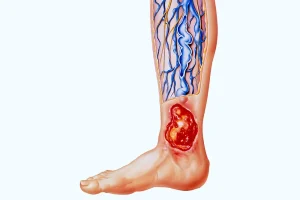 The picture illustrates a varicose ulcer on the leg.