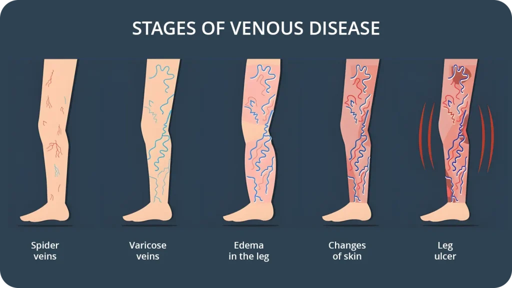 Diagram showing the stages of venous disease in the legs