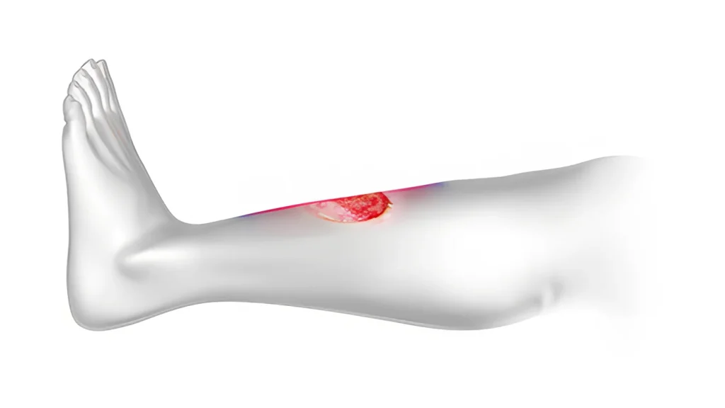 Image illustrating what a varicose ulcer on the leg looks like