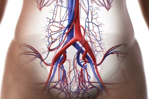 Representative image of pelvic varicose veins